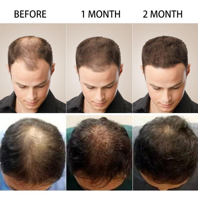 Saksraar Ginger Prevent Hair Loss Essential Oil is composed with traditional Chinese herbs to soften the hair strand and strengthen the scalp, resulting in a reduction of hair loss after continued use. Formulated with herbs such as ginseng extract, ginger extract and fleeceflower root, this serum will result in treated scalp and thicker hair. Recommended use for a minimum of two months for best results. Ingredient: Traditional Chinese medicine composition
